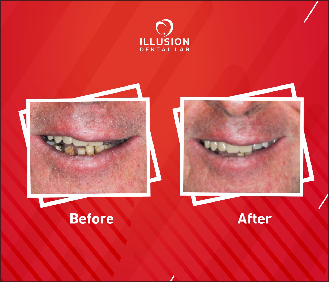 full mouth rehabilitation using ibar and zirconia bridge